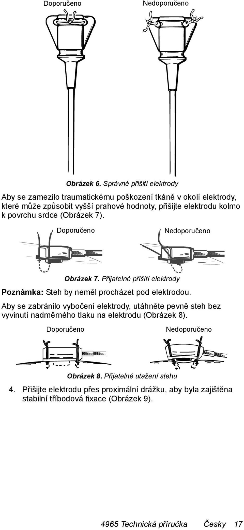 povrchu srdce (Obrázek 7). Doporučeno Nedoporučeno Obrázek 7. Přijatelné přišití elektrody Poznámka: Steh by neměl procházet pod elektrodou.