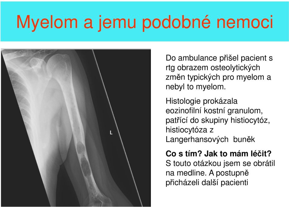 Histologie prokázala eozinofilní kostní granulom, patřící do skupiny histiocytóz,