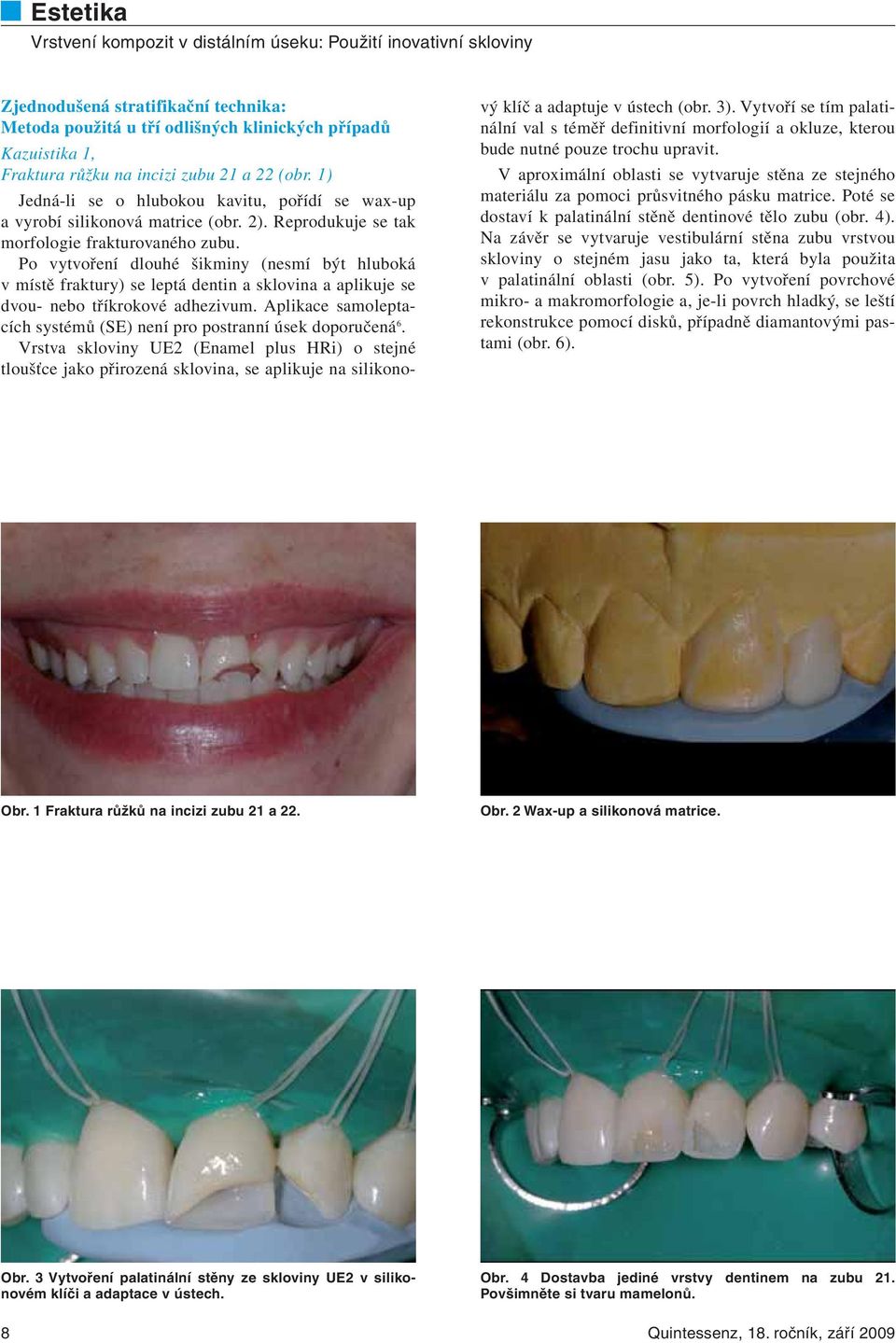 Po vytvoření dlouhé šikminy (nesmí být hluboká v místě fraktury) se leptá dentin a sklovina a aplikuje se dvou- nebo tříkrokové adhezivum.