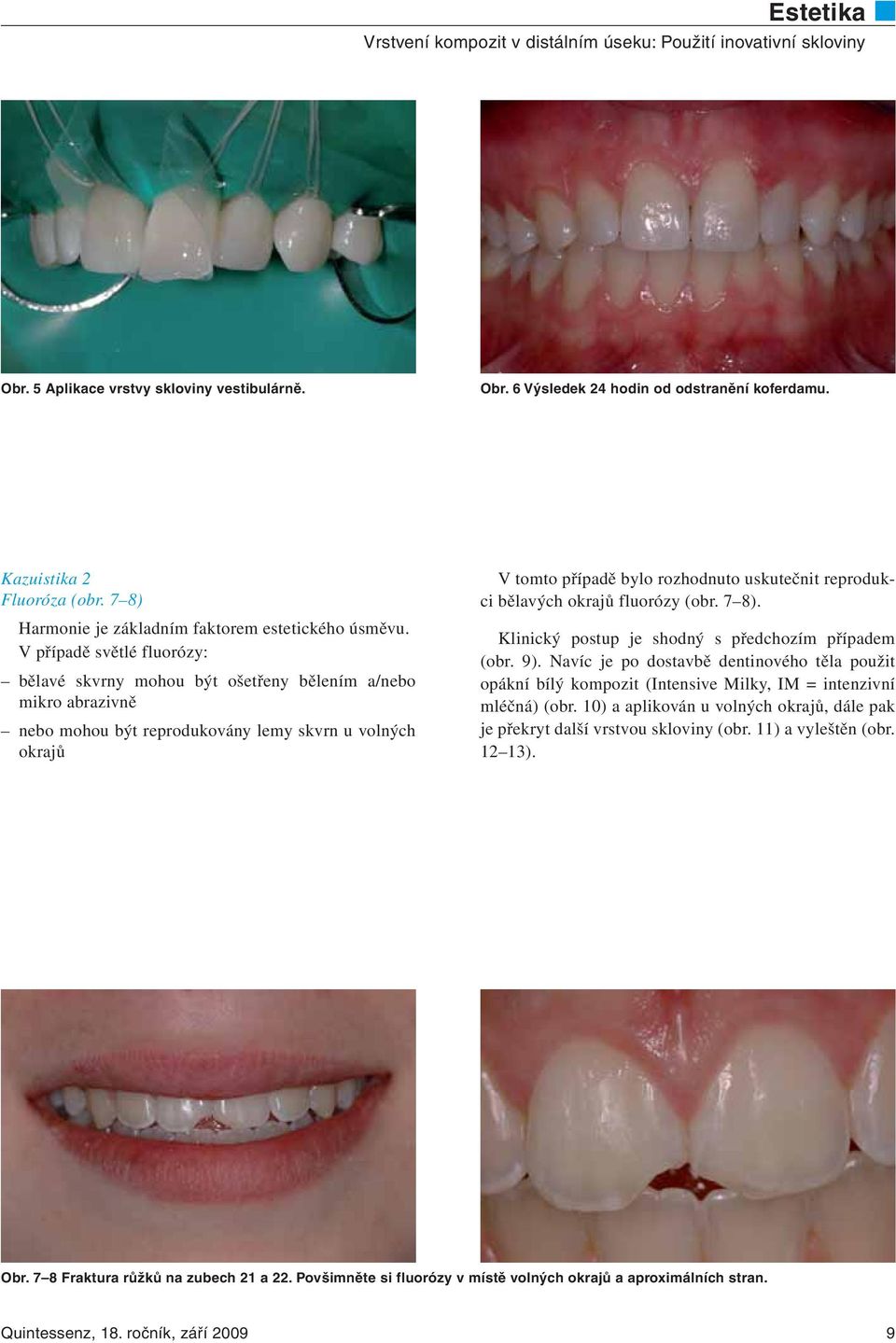 reprodukci bělavých okrajů fluorózy (obr. 7 8). Klinický postup je shodný s předchozím případem (obr. 9).
