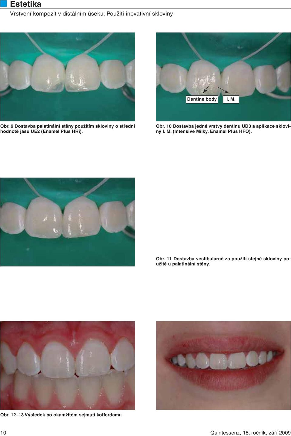 10 Dostavba jedné vrstvy dentinu UD3 a aplikace skloviny I. M. (Intensive Milky, Enamel Plus HFO).