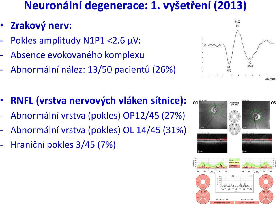 6 µv: - Absence evokovaného komplexu - Abnormální nález: 13/50 pacientů (26%)