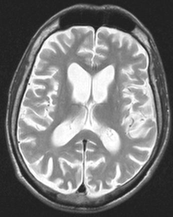 kazuistika 3 generalizovaná chorea diferenciální diagnóza Huntingtonova nemoc paraneoplastické postižení systémová vasculitis Fahrova nemoc příznak jazyka motor