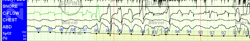 Dyssynchronie