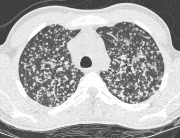 miliární TBC milární TBC spolu s TBC CNS patří mezi klinicky nejzávažnější formy TBC generalizovaná hematogenní diseminace mykobakterií z TBC ložiska charakter a stupěň postižení dle místa vstupu: