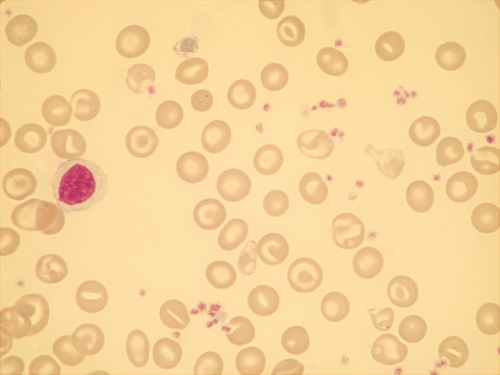 PORUCHY TVORBY HEMOGLOBINU NEMOCNÁ : HbH disease mutace 3 alfa globinových genů CSα/--SEA