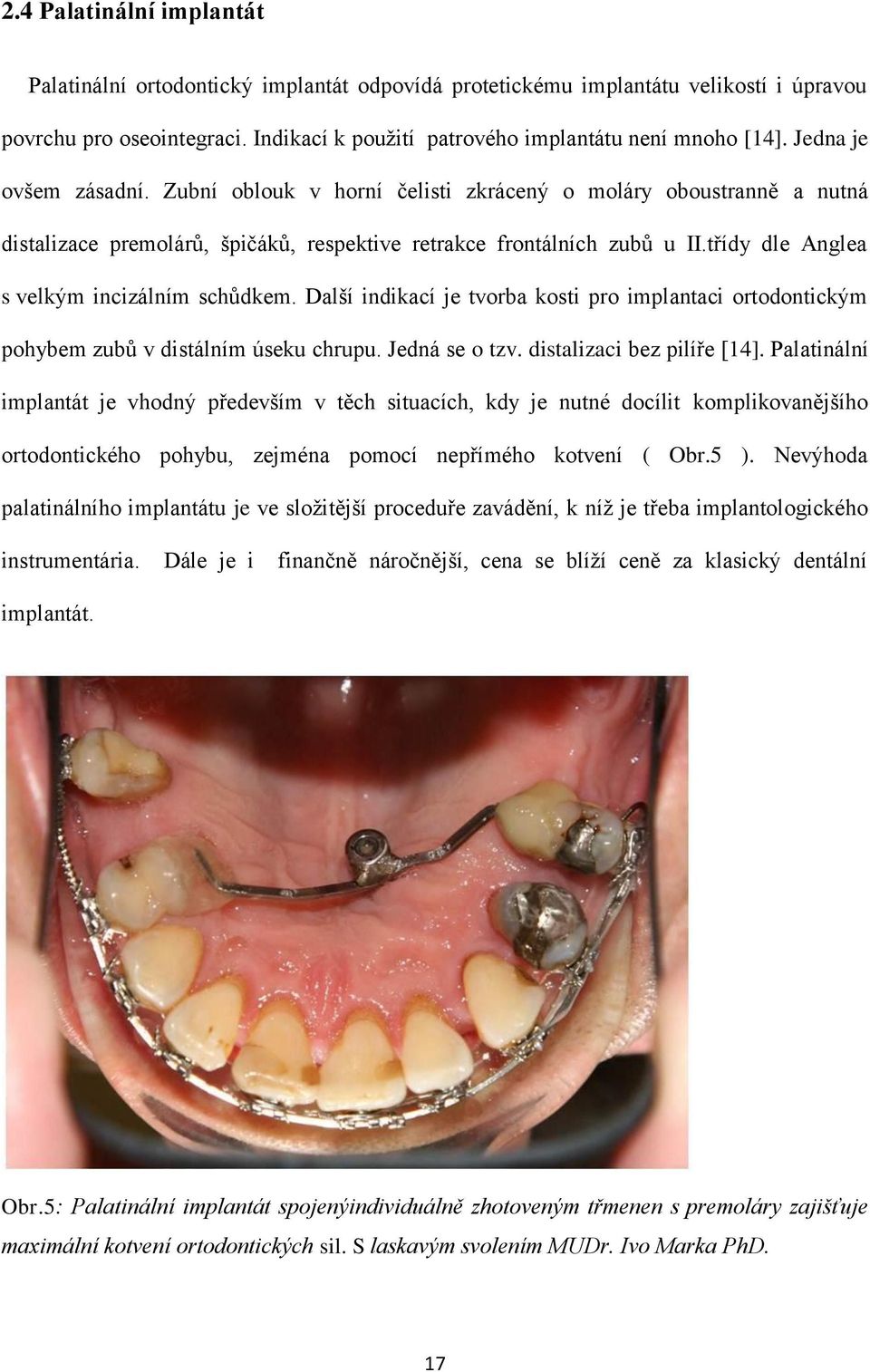 třídy dle Anglea s velkým incizálním schůdkem. Další indikací je tvorba kosti pro implantaci ortodontickým pohybem zubů v distálním úseku chrupu. Jedná se o tzv. distalizaci bez pilíře [14].