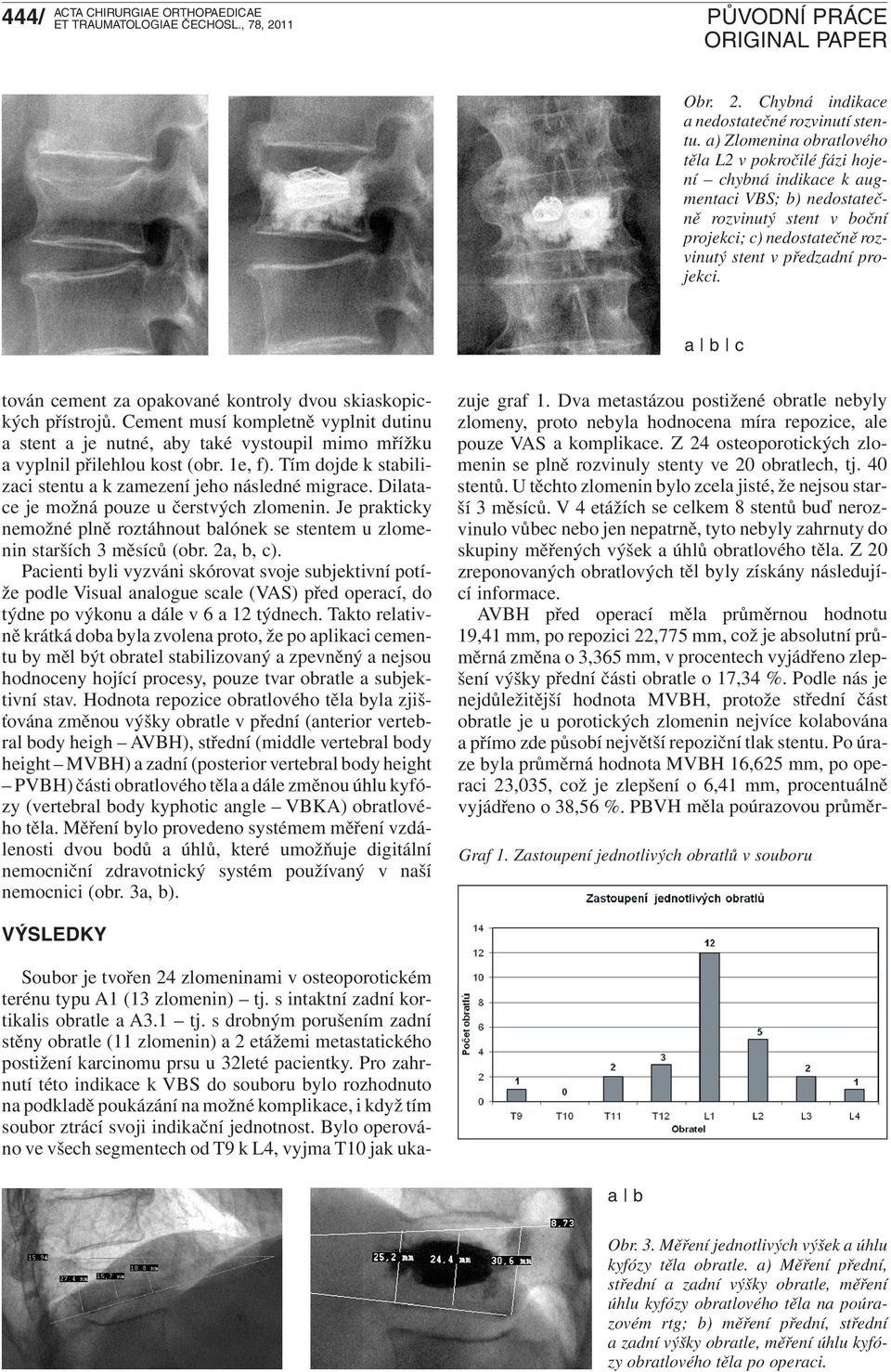 a b c tován cement za opakované kontroly dvou skiaskopických přístrojů. Cement musí kompletně vyplnit dutinu a stent a je nutné, aby také vystoupil mimo mřížku a vyplnil přilehlou kost (obr. 1e, f).