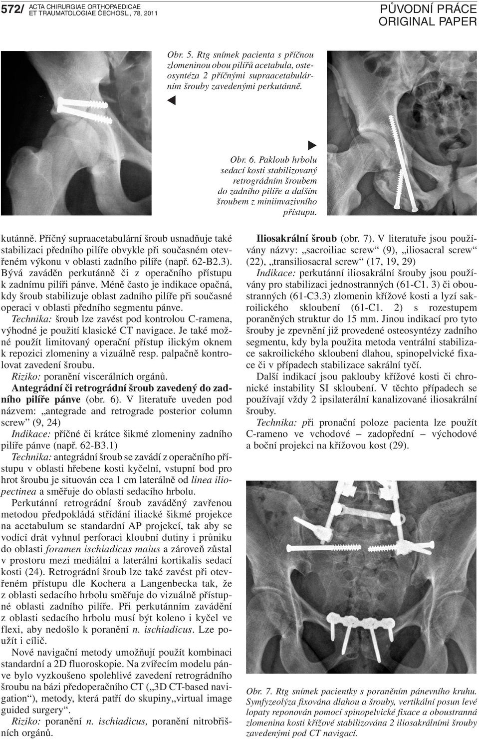 Příčný supraacetabulární šroub usnadňuje také stabilizaci předního pilíře obvykle při současném otevřeném výkonu v oblasti zadního pilíře (např. 62-B2.3).