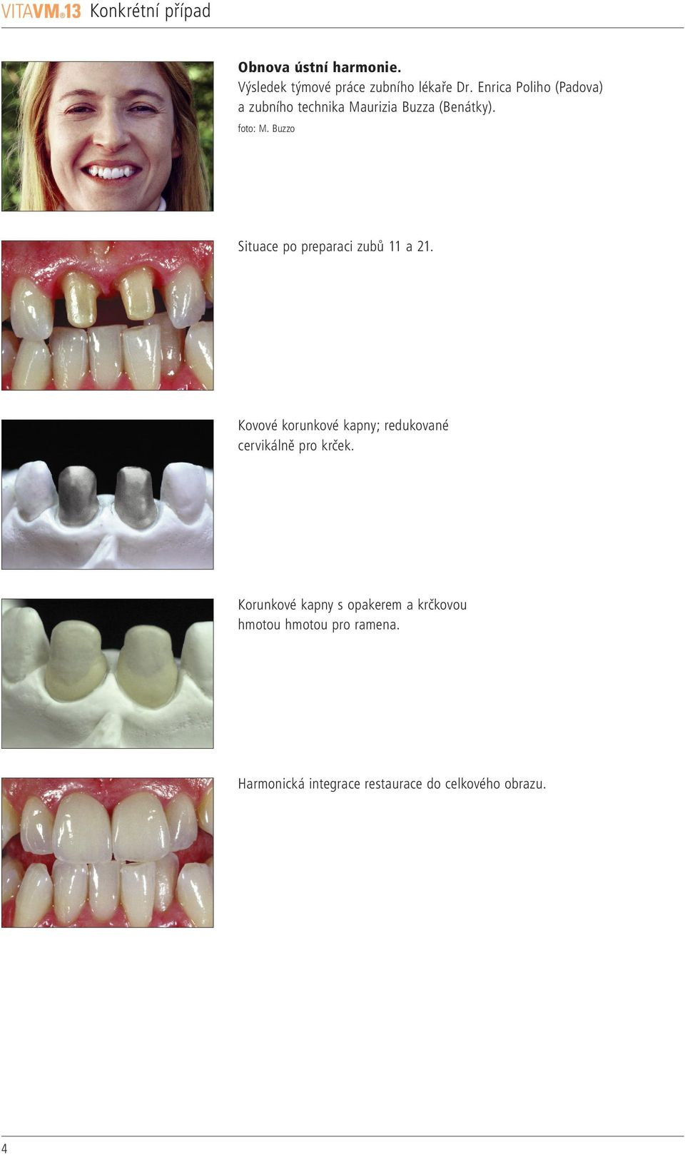 Buzzo Situace po preparaci zubů a 2. Kovové korunkové kapny; redukované cervikálně pro krček.