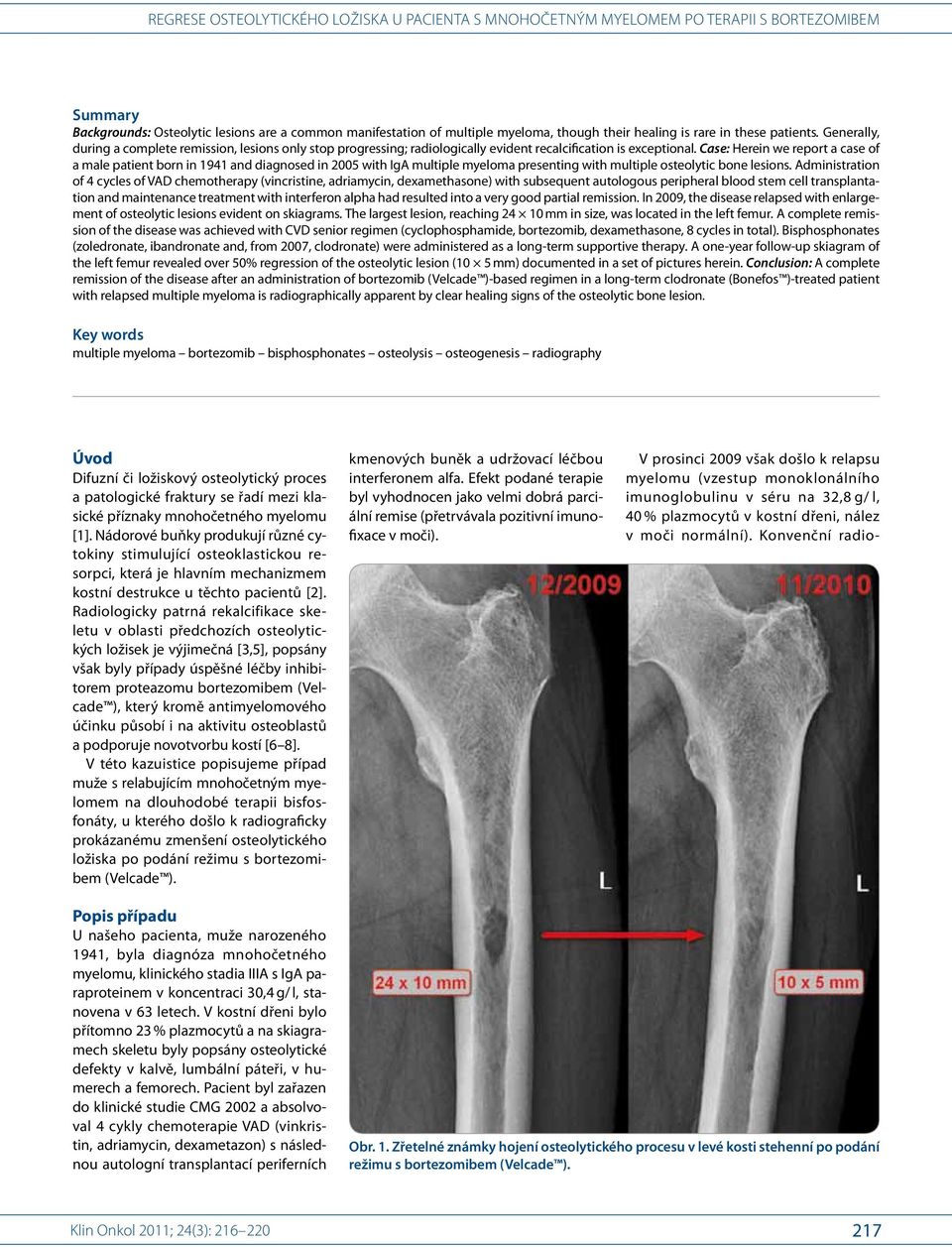 Case: Herein we report a case of a male patient born in 1941 and diagnosed in 2005 with IgA multiple myeloma presenting with multiple osteolytic bone lesions.