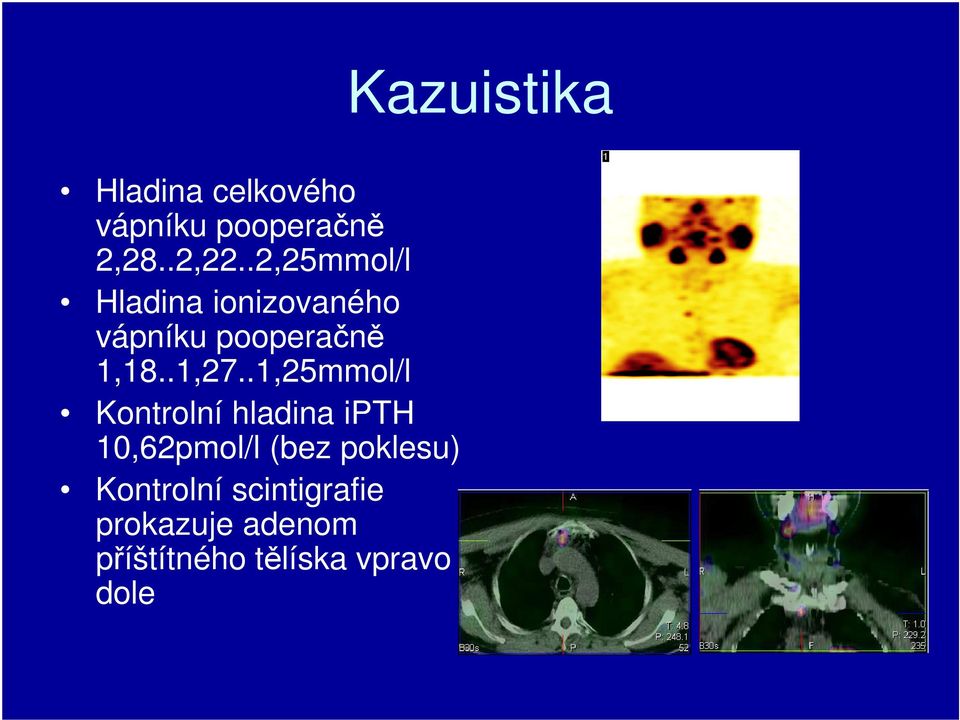 .1,25mmol/l Kontrolní hladina ipth 10,62pmol/l (bez poklesu)