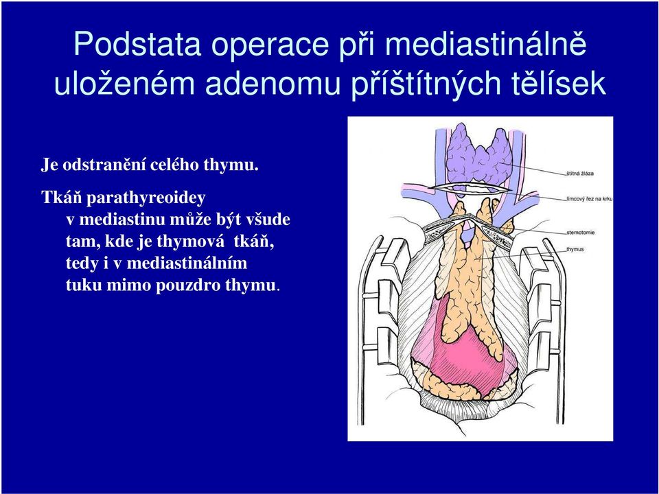 Tkáň parathyreoidey v mediastinu může být všude tam,