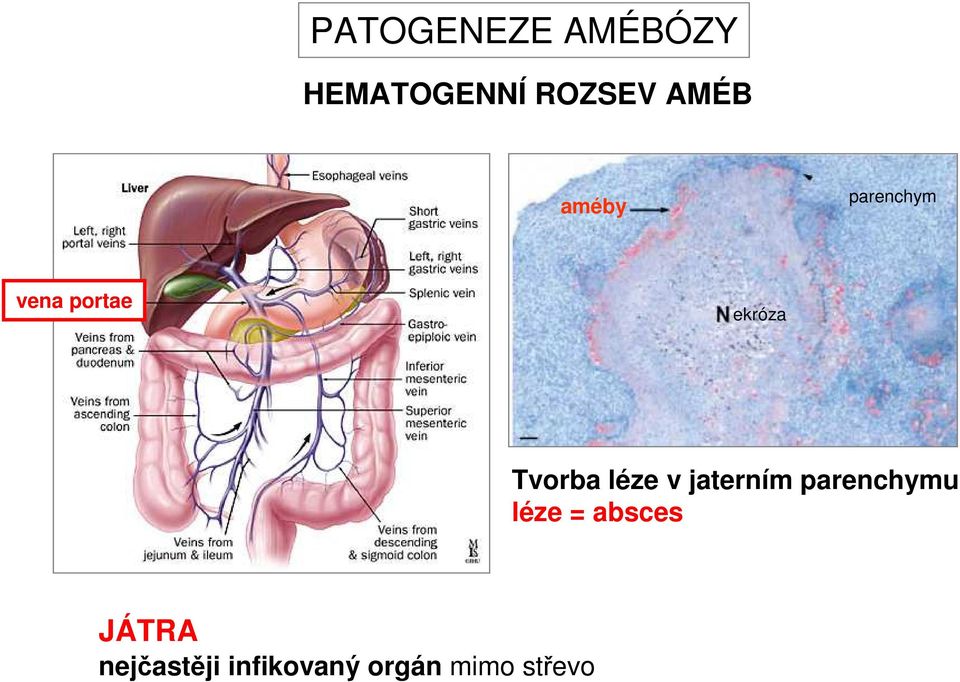 léze v jaterním parenchymu léze = absces