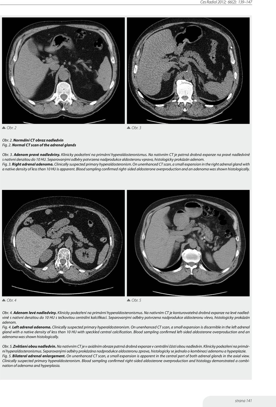 Right adrenal adenoma. Clinically suspected primary hyperaldosteronism. On unenhanced CT scan, a small expansion in the right adrenal gland with a native density of less than 10 HU is apparent.