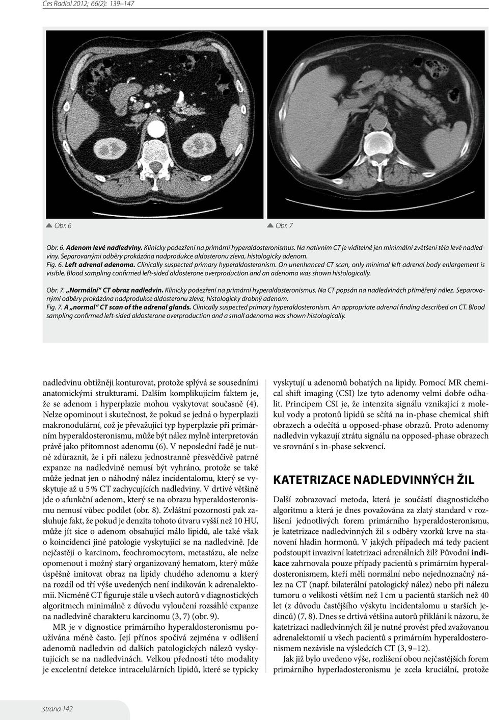 On unenhanced CT scan, only minimal left adrenal body enlargement is visible. Blood sampling confirmed left-sided aldosterone overproduction and an adenoma was shown histologically. Obr. 7.