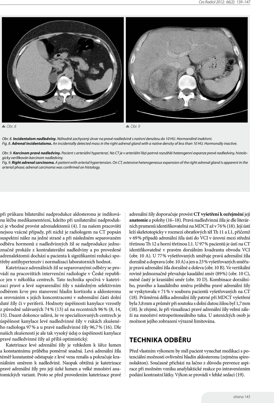 Na CT je v arteriální fázi patrná rozsáhlá heterogenní expanze pravé nadledviny, histologicky verifikován karcinom nadledviny. Fig. 9. Right adrenal carcinoma. A patient with arterial hypertension.