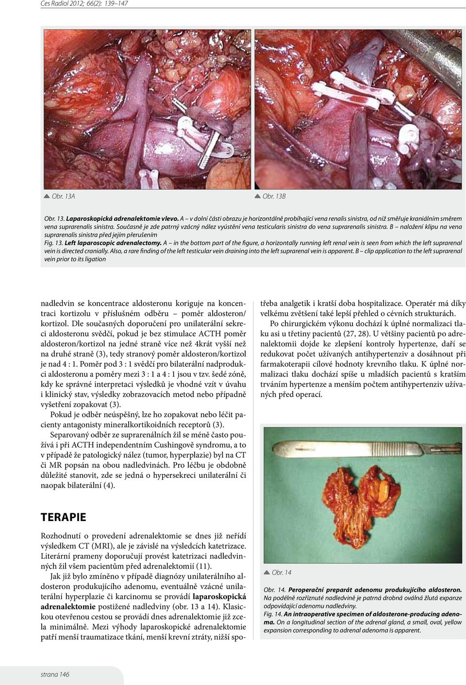 Left laparoscopic adrenalectomy. A in the bottom part of the figure, a horizontally running left renal vein is seen from which the left suprarenal vein is directed cranially.