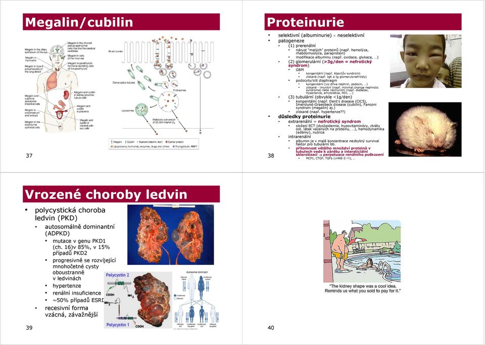 IgK a Ig glomerulonefritidy) podocyty/slit diaphragm kongenitální (viz dříve nephrin, podocin, ) získané - imunitní í( (např. ř minimal change nephrotic syndrome) nebo neimunitní (např.