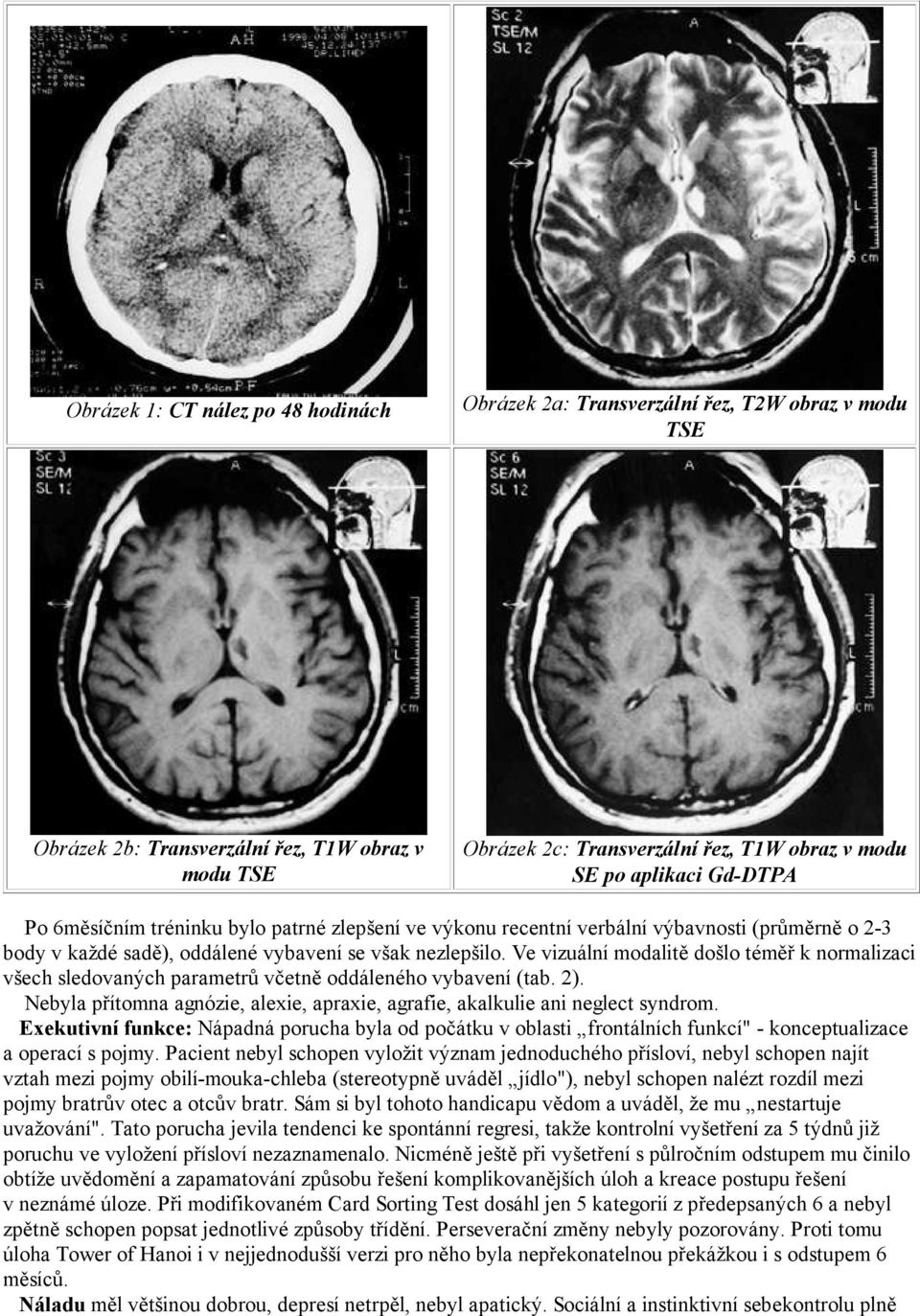 Ve vizuální modalitě došlo téměř k normalizaci všech sledovaných parametrů včetně oddáleného vybavení (tab. 2). Nebyla přítomna agnózie, alexie, apraxie, agrafie, akalkulie ani neglect syndrom.