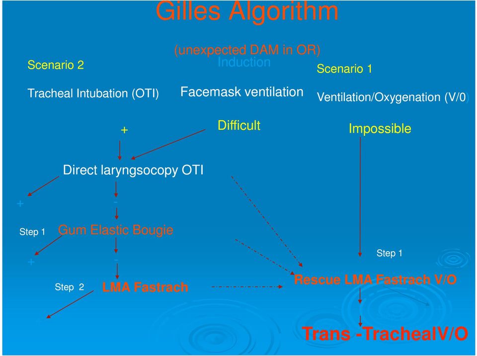 Difficult Impossible Direct laryngsocopy OTI + - Step 1 Gum Elastic Bougie +