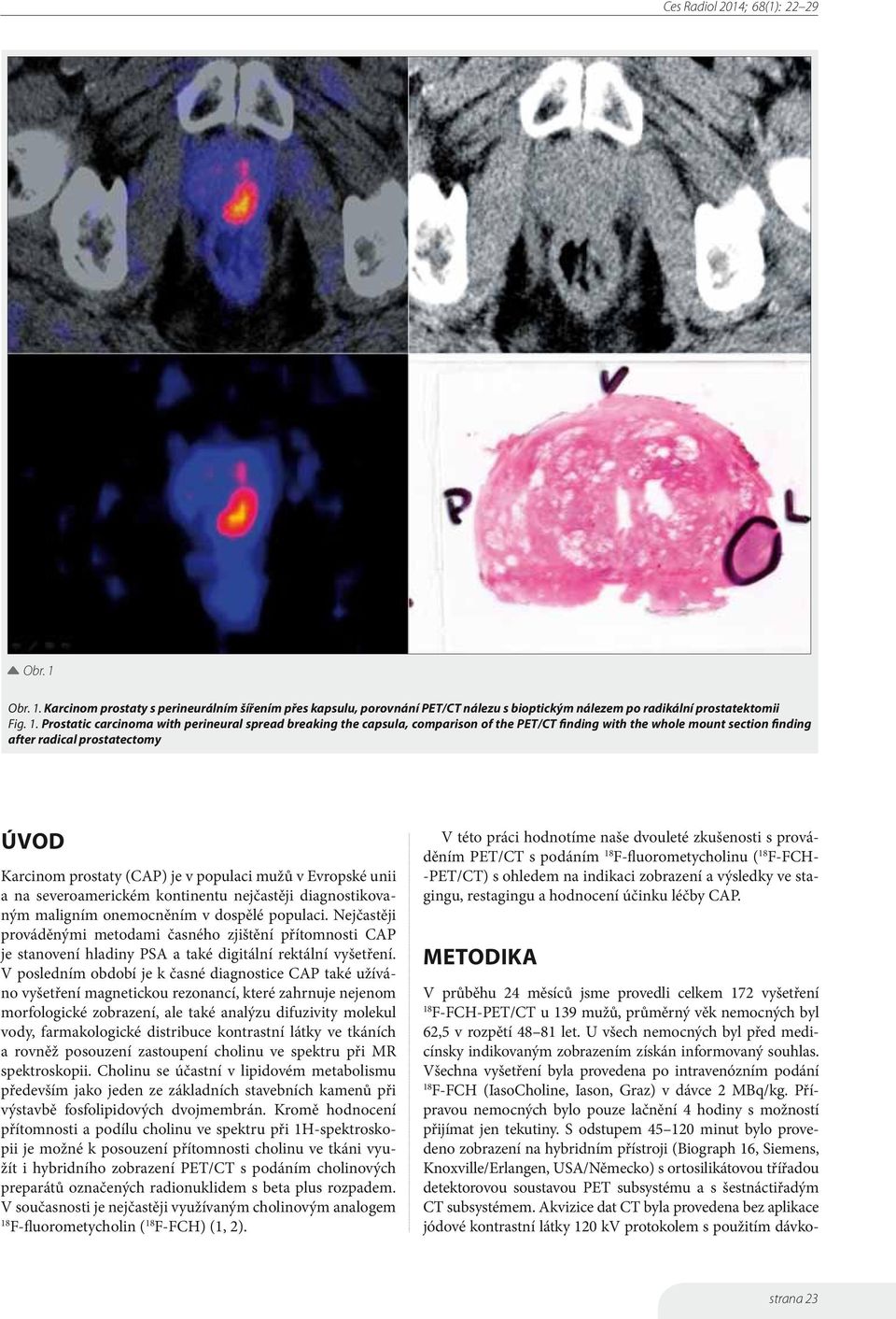 Karcinom prostaty s perineurálním šířením přes kapsulu, porovnání PET/CT nálezu s bioptickým nálezem po radikální prostatektomii Fig. 1.