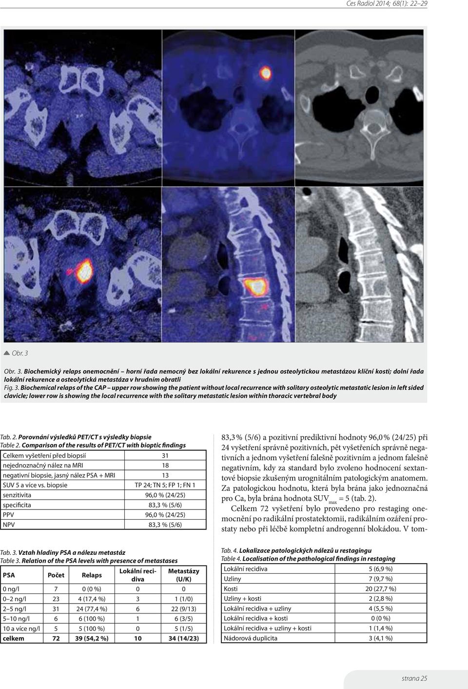 Biochemický relaps onemocnění horní řada nemocný bez lokální rekurence s jednou osteolytickou metastázou klíční kosti; dolní řada lokální rekurence a osteolytická metastáza v hrudním obratli Fig. 3.