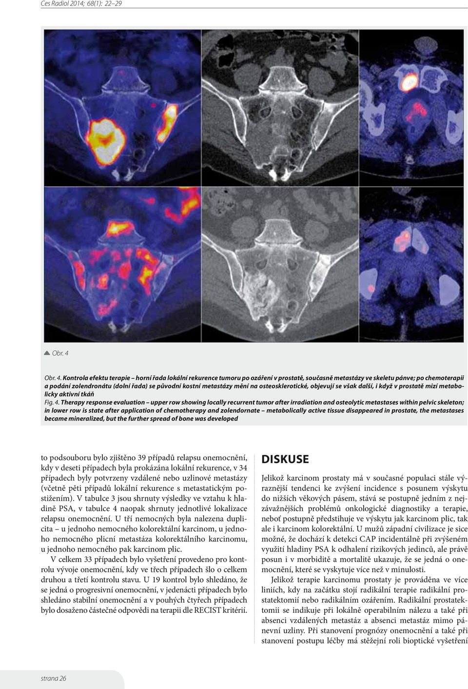 Kontrola efektu terapie horní řada lokální rekurence tumoru po ozáření v prostatě, současně metastázy ve skeletu pánve; po chemoterapii a podání zolendronátu (dolní řada) se původní kostní metastázy