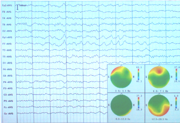 převedení EEG dat pomocí FFT. Výsledný obrázek připomíná výsledky z CT vyšetření či magnetické rezonance, avšak při klasickém rozložení elektrod (10-20) je rozlišení BM rozpoznatelně nižší.