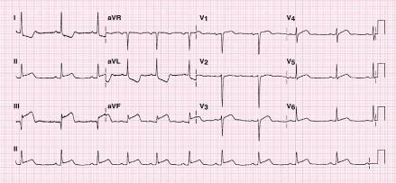 Elektrokardiogram diagnostika příčiny srdečního