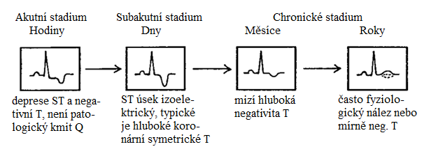 vzniklou prasknutím aterosklerotického plátu. Infarkt myokardu se subjektivně projevuje tupou svíravou bolestí vznikající na hrudi a šířící se do hrdla, čelisti, ramen, paží a prstů.