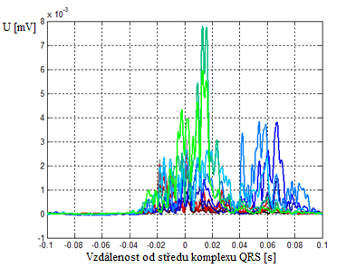 Obr. 20 Obálky UHF EKG signálu u pacienta s LBBB, barvy jednotlivých svodů odpovídají situaci na obr.