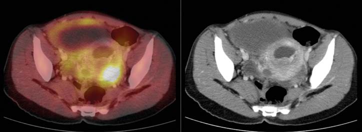 Obr. 9. PET vyšetření 1. 12. 2014, fúze PET/CT (játra) Obr. 10. PET vyšetření 1. 12. 2014, fúze PET/CT (pánev) Obr. 11.