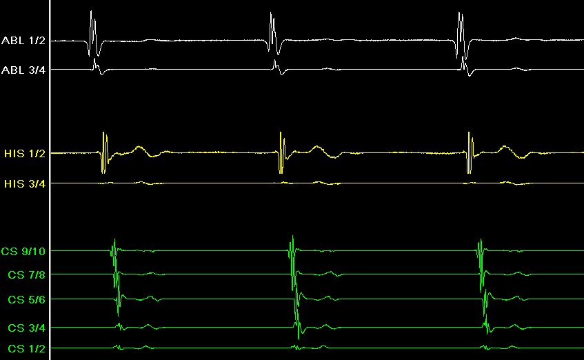 Na základě všech těchto informací je stanoven další léčebný postup s možností indikace radiofrekvenční ablace, jež u mnoha arytmií navazuje na část diagnostickou, [5]. Obr.