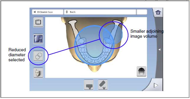9 3D SNÍMKOVÁNÍ 9.2.10 Zmenšení průměru přidaných objemů (dvojitý/trojitý sken) Při dvojitém a trojitém skenu mají objemy stejný průměr.