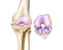 B. Operační léčba (Janíček 2001) Preventivní primární výkony parciální menisektomie, odstranění kloubních myšek Preventivní sekundární výkony osteotomie ke korekci osové deformity, plastiky