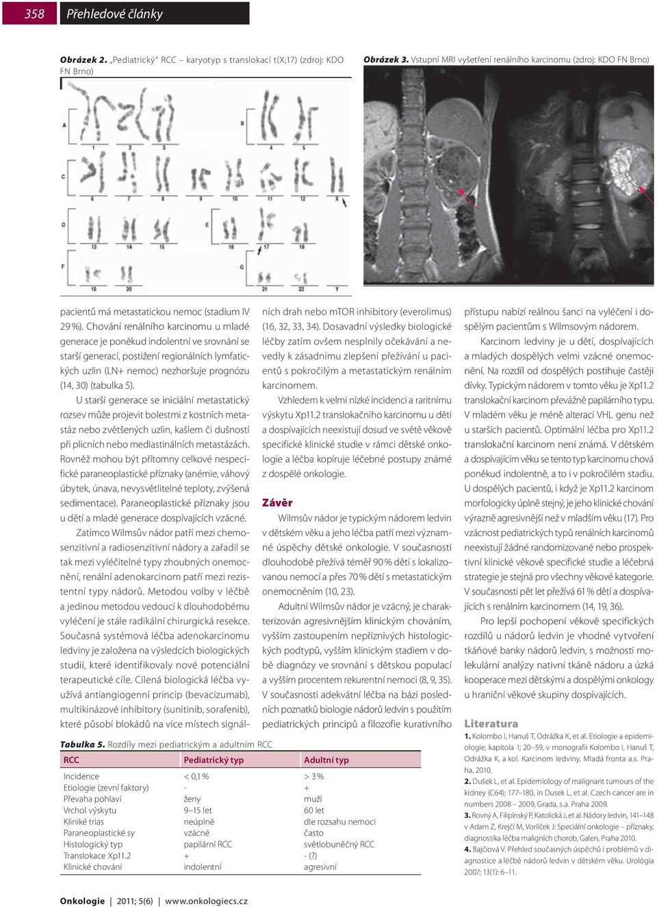 Translokace Xp11.2 Klinické chování < 0,1 % - ženy 9 15 let neúplné vzácné papilární RCC + indolentní pacientů má metastatickou nemoc (stadium IV 29 %).