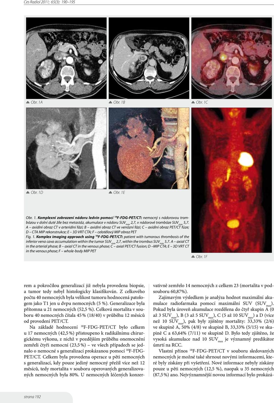 Komplex imaging approach using F-FDG-PET/CT: patient with tumorous thrombosis of the inferior vena cava accumulation within the tumor SUV max 2,7,