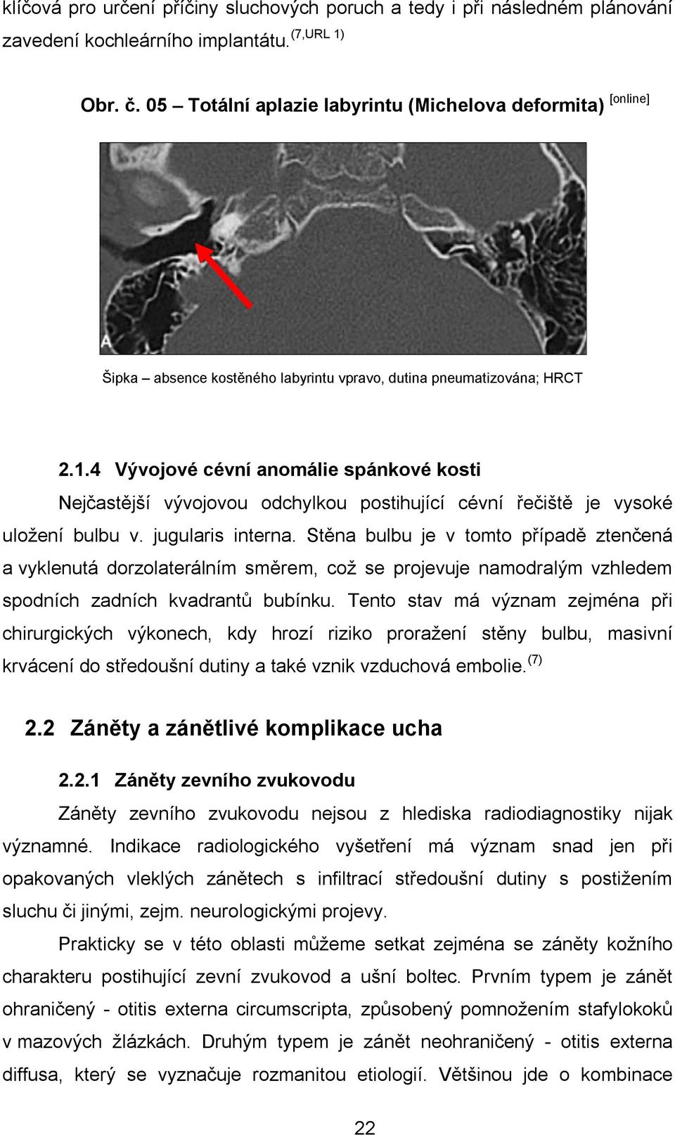 4 Vývojové cévní anomálie spánkové kosti Nejčastější vývojovou odchylkou postihující cévní řečiště je vysoké uložení bulbu v. jugularis interna.