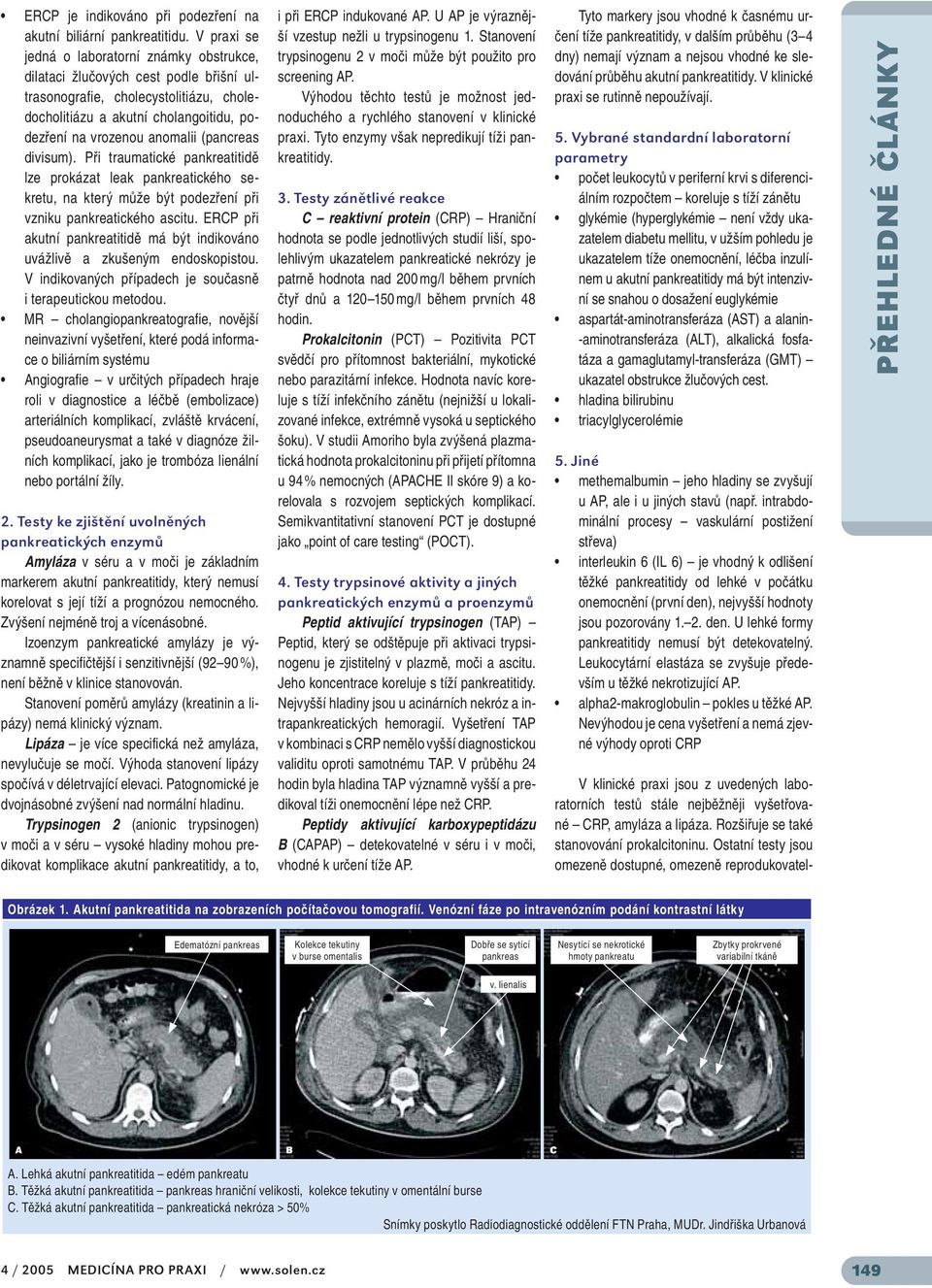 (pancreas divisum). Při traumatické pankreatitidě lze prokázat leak pankreatického sekretu, na který může být podezření při vzniku pankreatického ascitu.