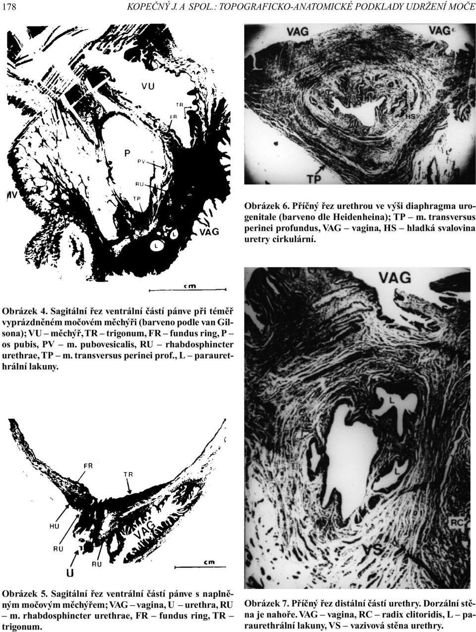 Sagitální øez ventrální èástí pánve pøi témìø vyprázdnìném moèovém mìchýøi (barveno podle van Gilsona); VU mìchýø, TR trigonum, FR fundus ring, P os pubis, PV m.