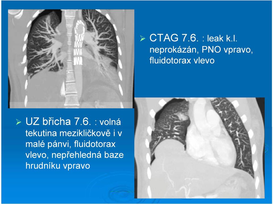 neprokázán, PNO vpravo, fluidotorax vlevo