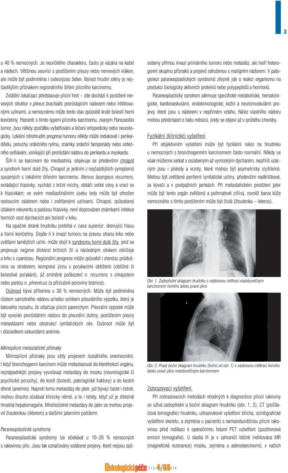 Zvláštní lokalizaci představuje plicní hrot zde dochází k postižení nervových struktur v plexus brachialis prorůstajícím nádorem nebo infiltrovanými uzlinami, a nemocnému může tento stav způsobit