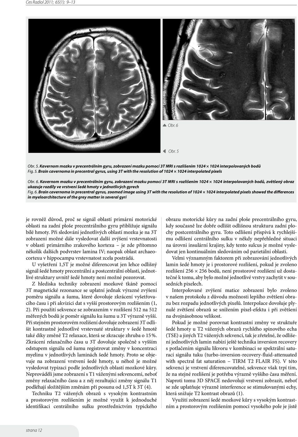 Brain cavernoma in precentral gyrus, zoomed image using 3T with the resolution of 1024 1024 interpolated pixels showed the differences in myeloarchitecture of the grey matter in several gyri je