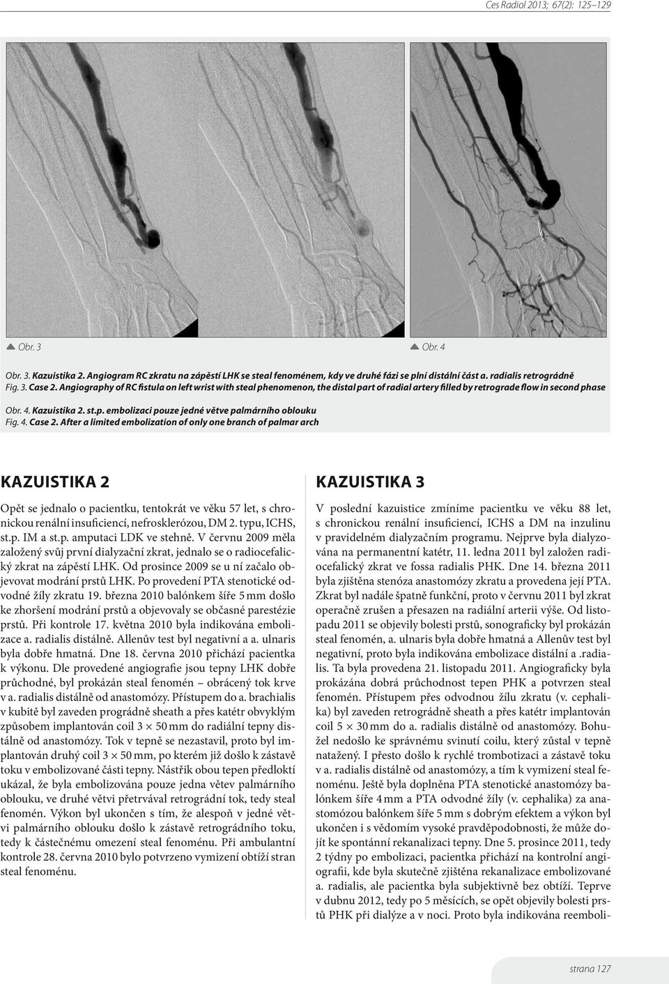 4. Case 2. After a limited embolization of only one branch of palmar arch Kazuistika 2 Opět se jednalo o pacientku, tentokrát ve věku 57 let, s chronickou renální insuficiencí, nefrosklerózou, DM 2.