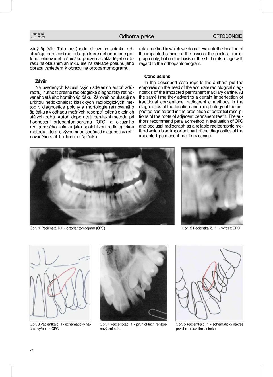 vzhledem k obrazu na ortopantomogramu. Závěr Na uvedených kazuistických sděleních autoři zdůrazňují nutnost přesné radiologické diagnostiky retinovaného stálého horního špičáku.