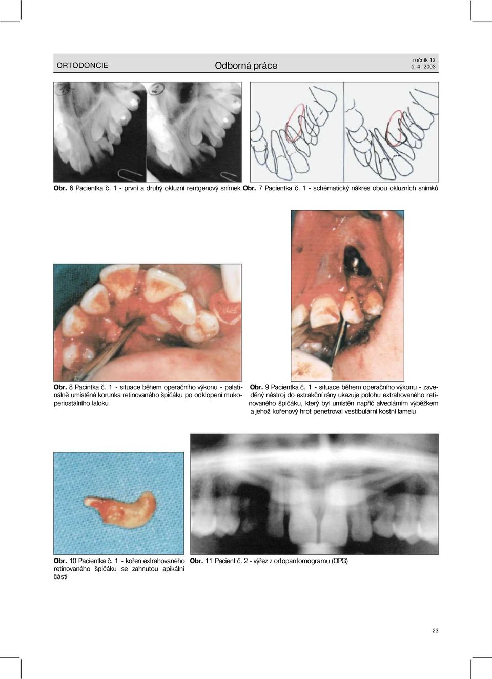 výběžkem a jehož kořenový hrot penetroval vestibulární kostní lamelu Obr. 8 Pacintka č.