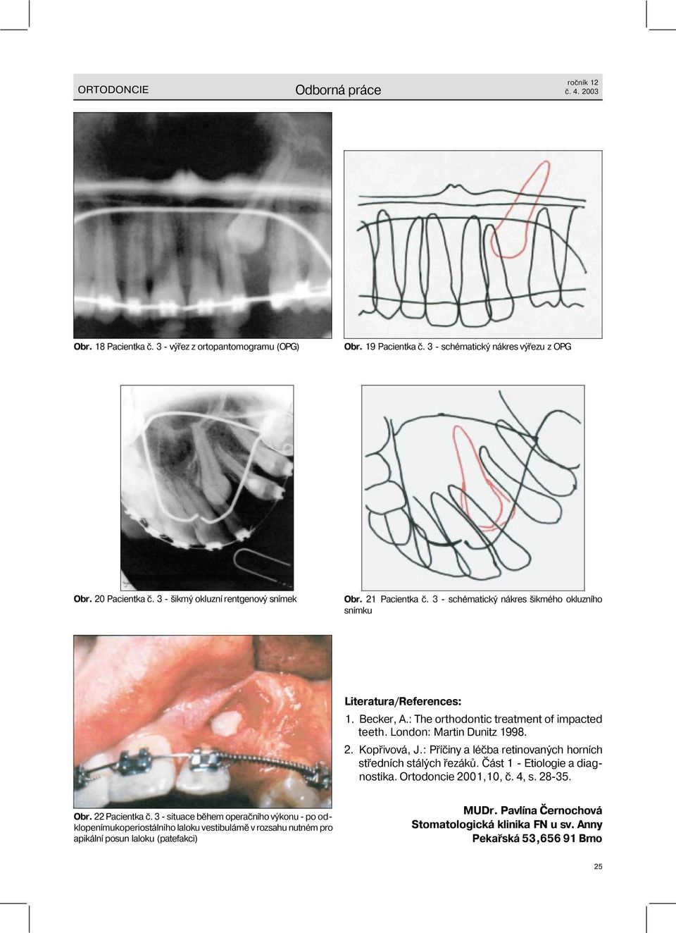 Kopřivová, J.: Příčiny a léčba retinovaných horních středních stálých řezáků. Část 1 - Etiologie a diagnostika. Ortodoncie 2001,10, č. 4, s. 28-35. Obr. 22 Pacientka č.