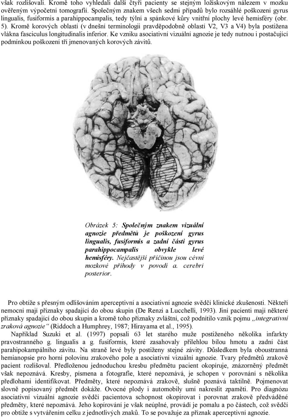 Kromě korových oblastí (v dnešní terminologii pravděpodobně oblastí V2, V3 a V4) byla postižena vlákna fasciculus longitudinalis inferior.