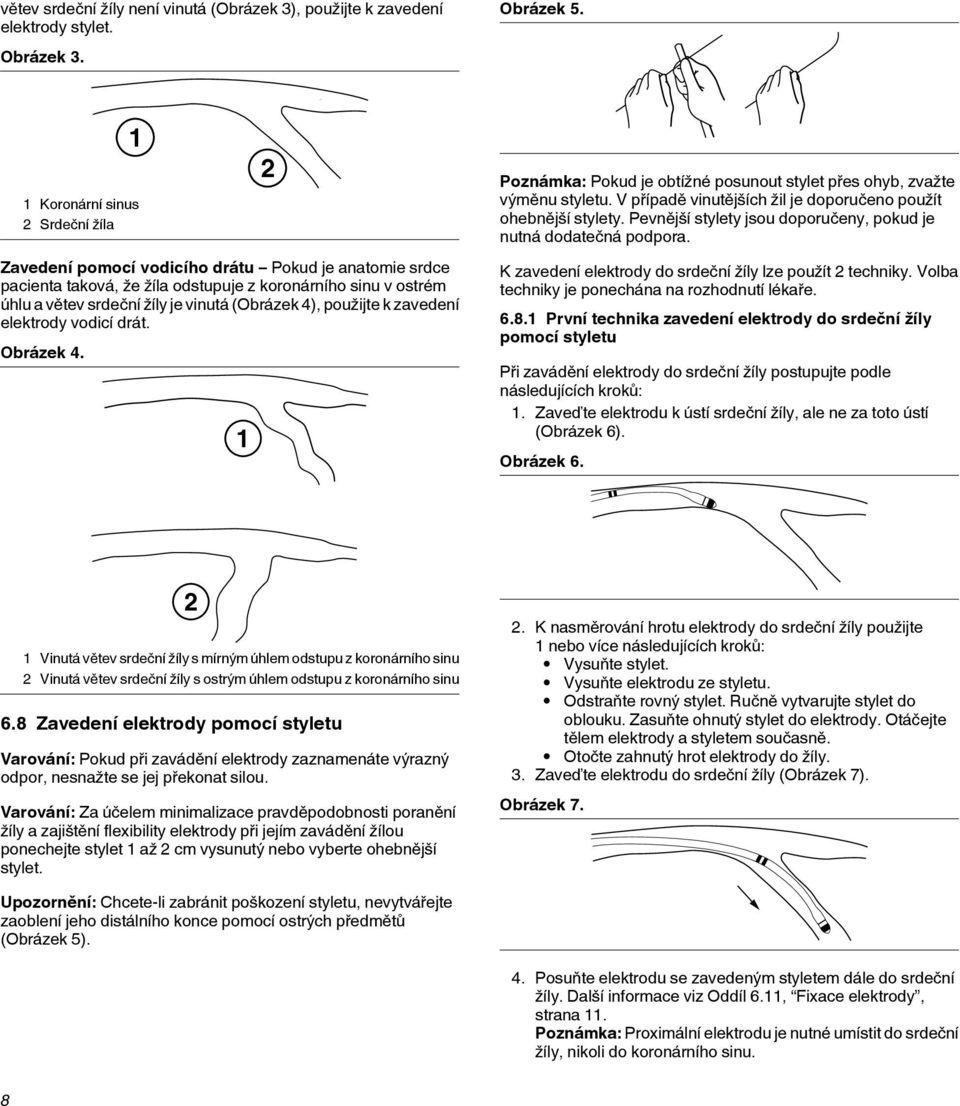 4), použijte k zavedení elektrody vodicí drát. Obrázek 4. 1 2 Poznámka: Pokud je obtížné posunout stylet přes ohyb, zvažte výměnu styletu.